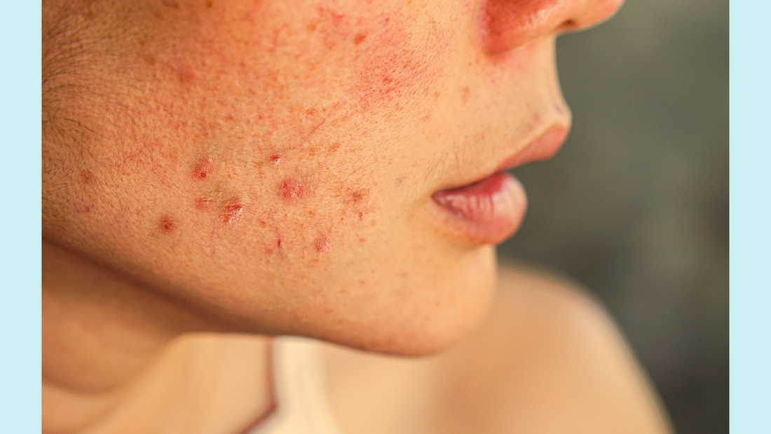 Does using a cleansing balm cause acne? – Dreamy Atoms