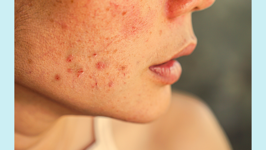 Does using a cleansing balm cause acne?